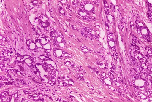 This 1974 microscope image made available by the Centers for Disease Control and Prevention shows changes in cells indicative of adenocarcinoma of the prostate. A study published by the New England Journal of Medicine on Saturday, March 11, 2023, finds long-term evidence that actively monitoring prostate cancer can be a safe alternative to immediate surgery or radiation. (Dr. Edwin P. Ewing, Jr./CDC via AP)